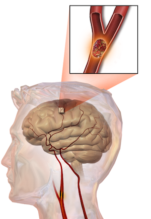 Stroke, What Is a Stroke?, What Is Stroke