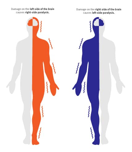 Stroke recovery stage 1 left side of brain / right side of brain paralysis