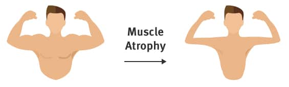 Stroke recovery stage 1 - muscle atrophy suffering