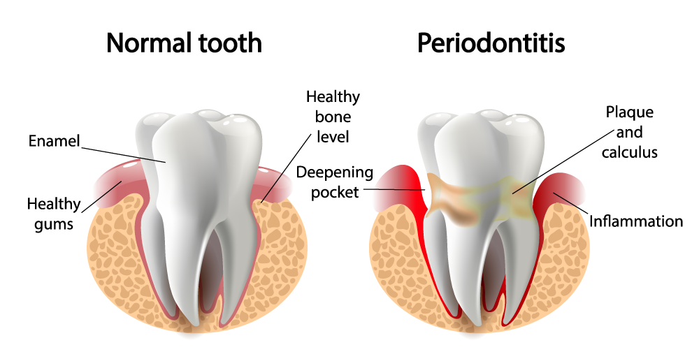 Periodontitis, Gum Disease, Gum Disease and Stroke
