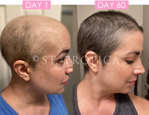 Chemotherapy And Hair Loss - ST. TROPICA
