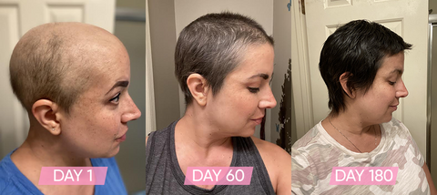 Chemotherapy And Hair Loss  ST TROPICA