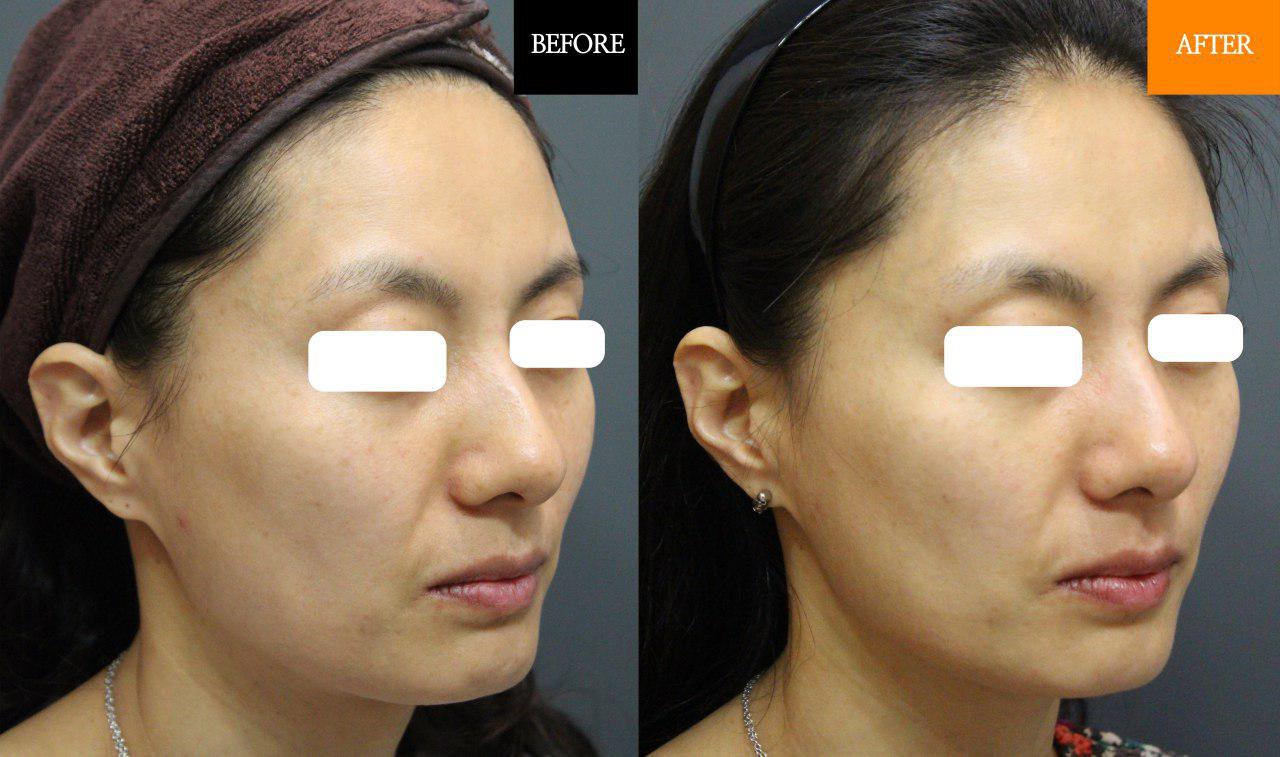 Immediate V-Line and skin tightening effect