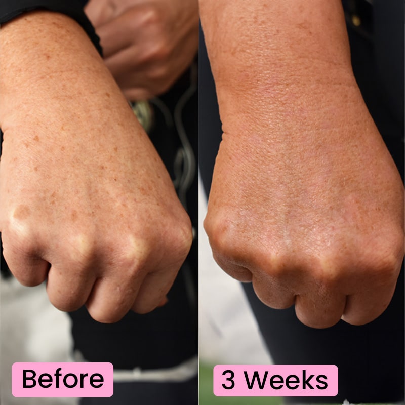 Before and after skincare results showing reduced pigmentation on a hand over three weeks.