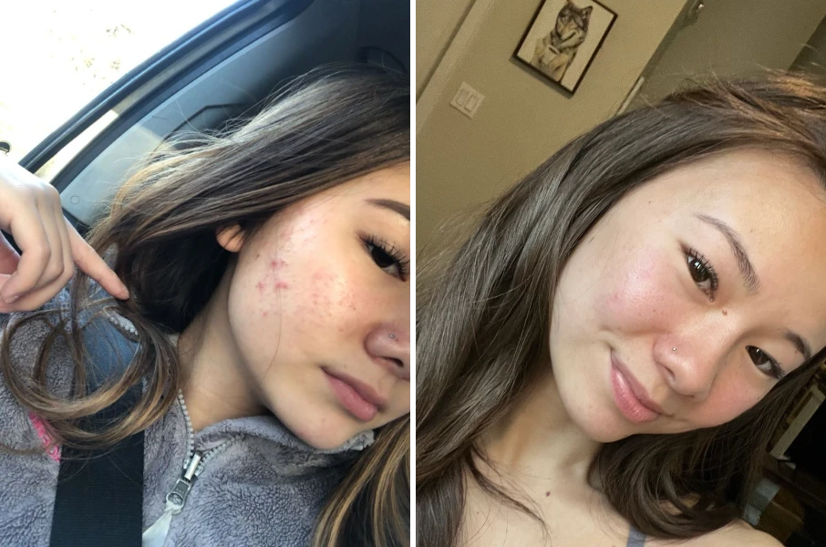 A side-by-side comparison of a person's face before and after acne treatment, showing clear skin improvement.