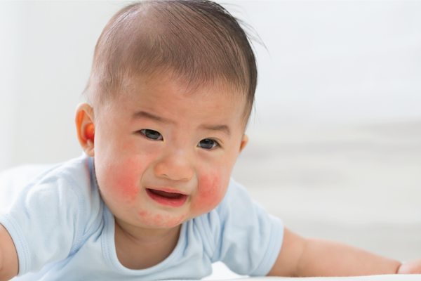 bayi dengan bintik merah pada pipi