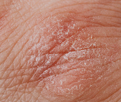 Dead skins cells creating flaking appearance