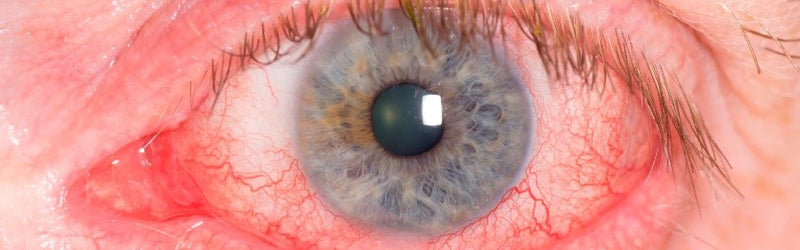 Ocular Rosacea