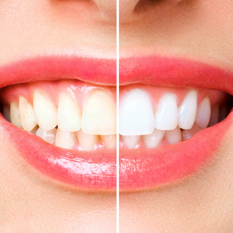 A close up of a woman's mouth smiling with a verticle dividing line down the middle of her mouth. On the left her teeth are yellowish and on the right her teeth are white.