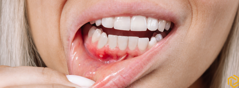 A woman holding her lip to expose her gums with a canker sore