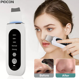 Ultrasonic Ion Skin Scrubber Blackhead Remover Deep Face Cleaning Tool - Chic Joya