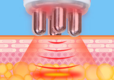 radiofrequency probe