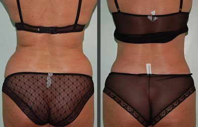 appareil lipocavitation resultat 2