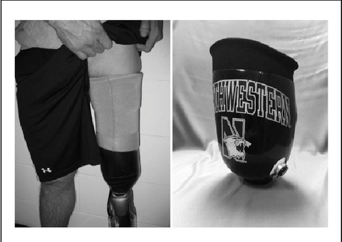 Subischial prosthetic socket designed by Northwestern University.