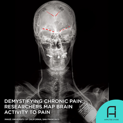 Researchers seek to understand chronic pain by mapping the brain's response to pain.