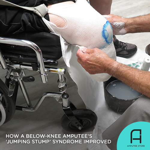 A medical team improved a below-knee amputee's jumping stump syndrome.