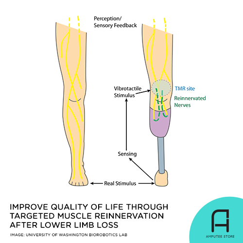 Targeted Muscle Reinnervation could help improve pain after lower limb loss.