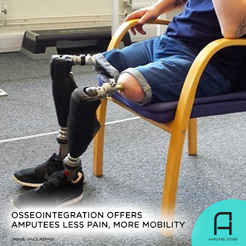 Osseointegration, a procedure that involves surgically implanting a metal bar, offers amputees less pain and more mobility.