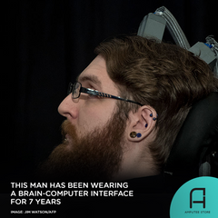 Nathan Copeland has been wearing a brain-computer interface for more than 7 years.
