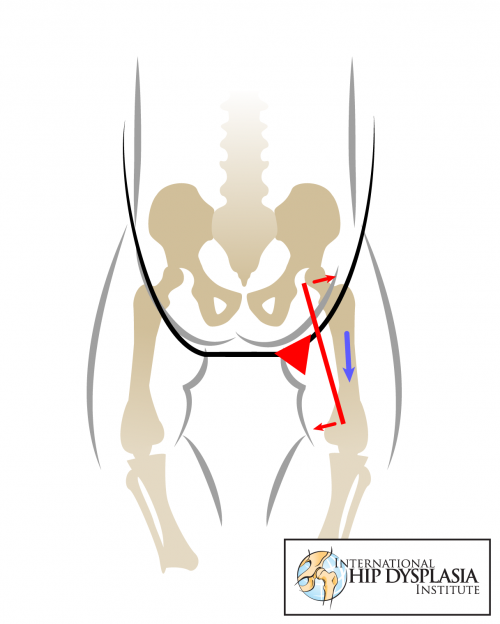 pressure on baby's lower spine and unsupported hips can lead to hip dysplasia