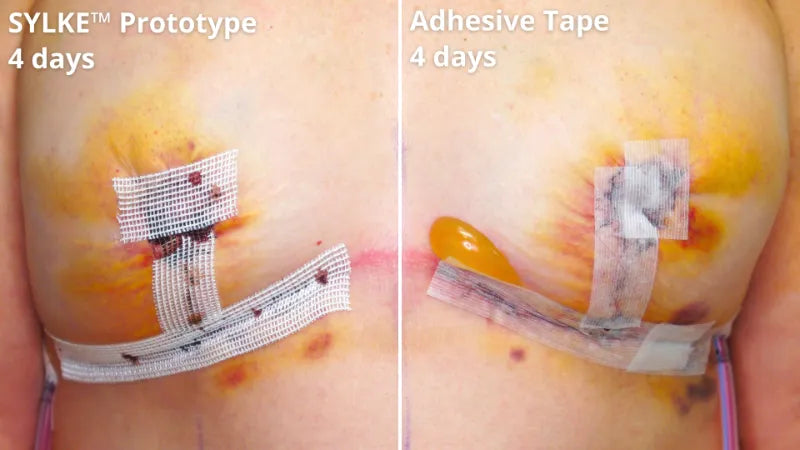 2 sylke before after showing decreased blistering.webp__PID:22ce3f30-b90e-42bf-890d-0ba0bbb44825