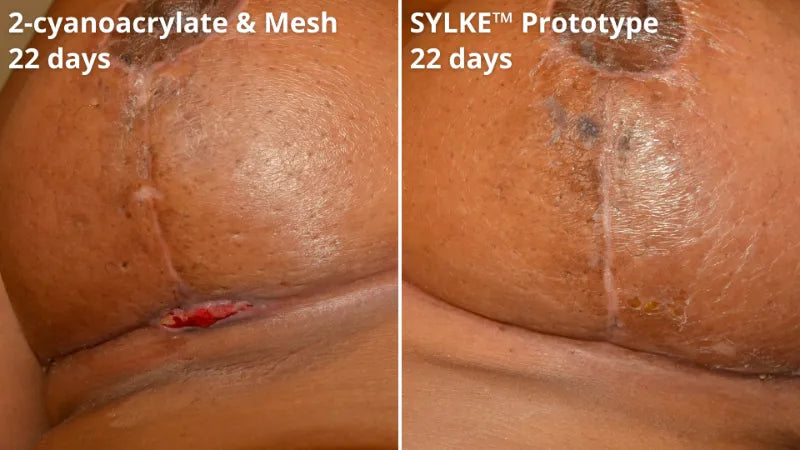 3 sylke before after showing reduced wound dehiscence.webp__PID:ce3f30b9-0e82-4f49-8d0b-a0bbb4482540