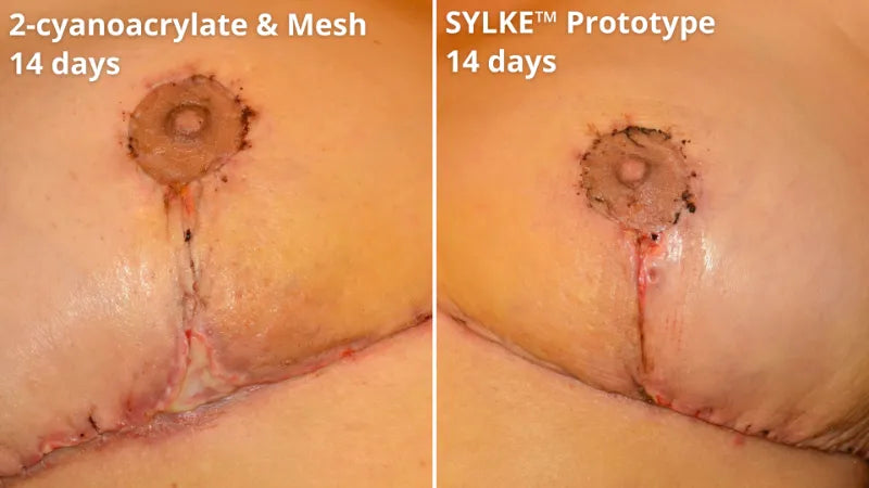 4 sylke before after showing reduced wound dehiscence.webp__PID:3f30b90e-82bf-490d-8ba0-bbb44825402f