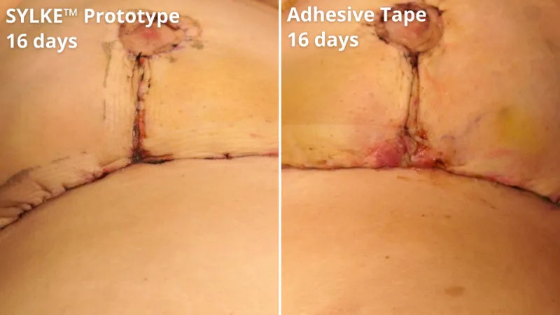 5 sylke before after showing improved wound healing.webp__PID:30b90e82-bf49-4d0b-a0bb-b44825402f30