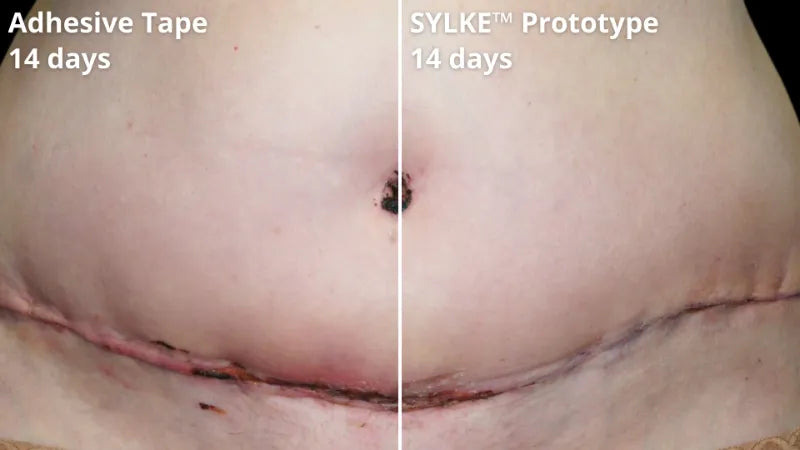 6 sylke before after showing improved wound healing.webp__PID:b90e82bf-490d-4ba0-bbb4-4825402f300b