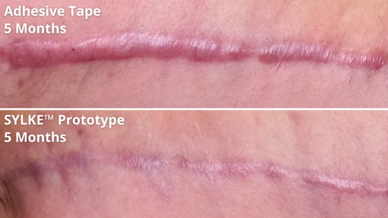 7 sylke before after showing improved scar outcomes.webp__PID:0e82bf49-0d0b-40bb-b448-25402f300b44