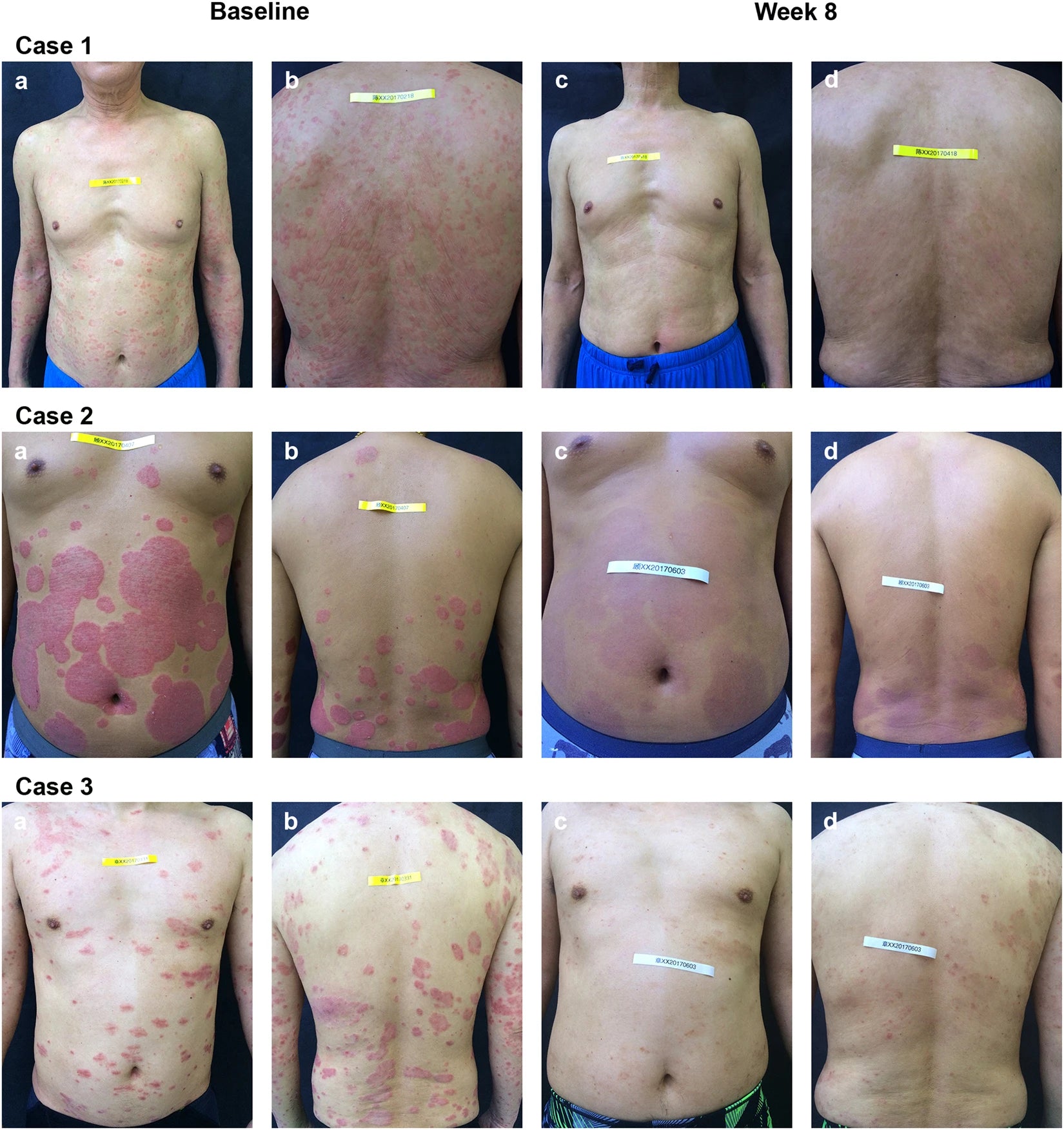 Clinical improvement of psoriasis