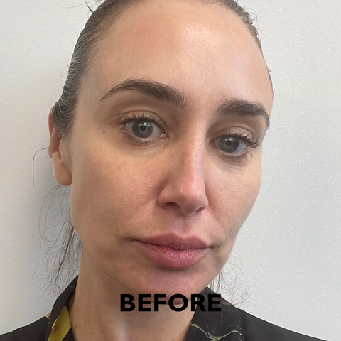 BABY FACE LASER BEFORE AND AFTER