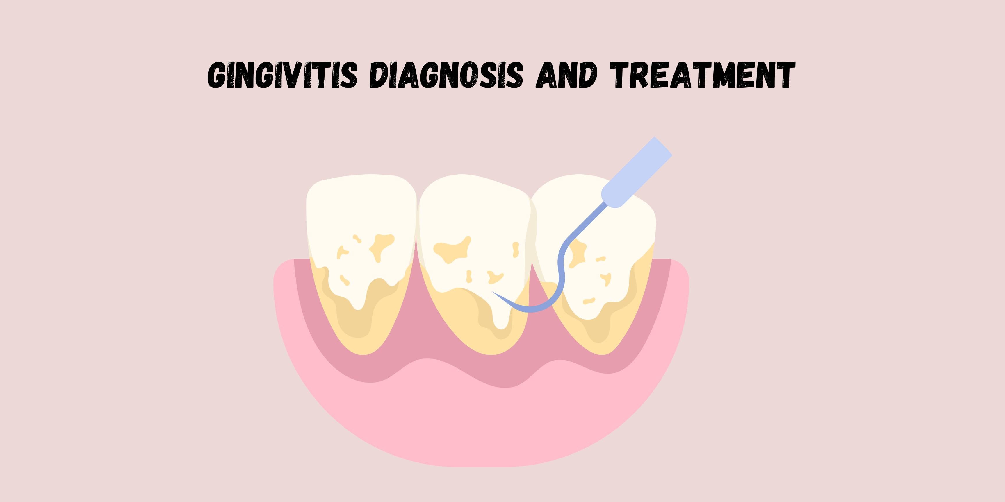 Gingivitis Diagnosis and Treatment