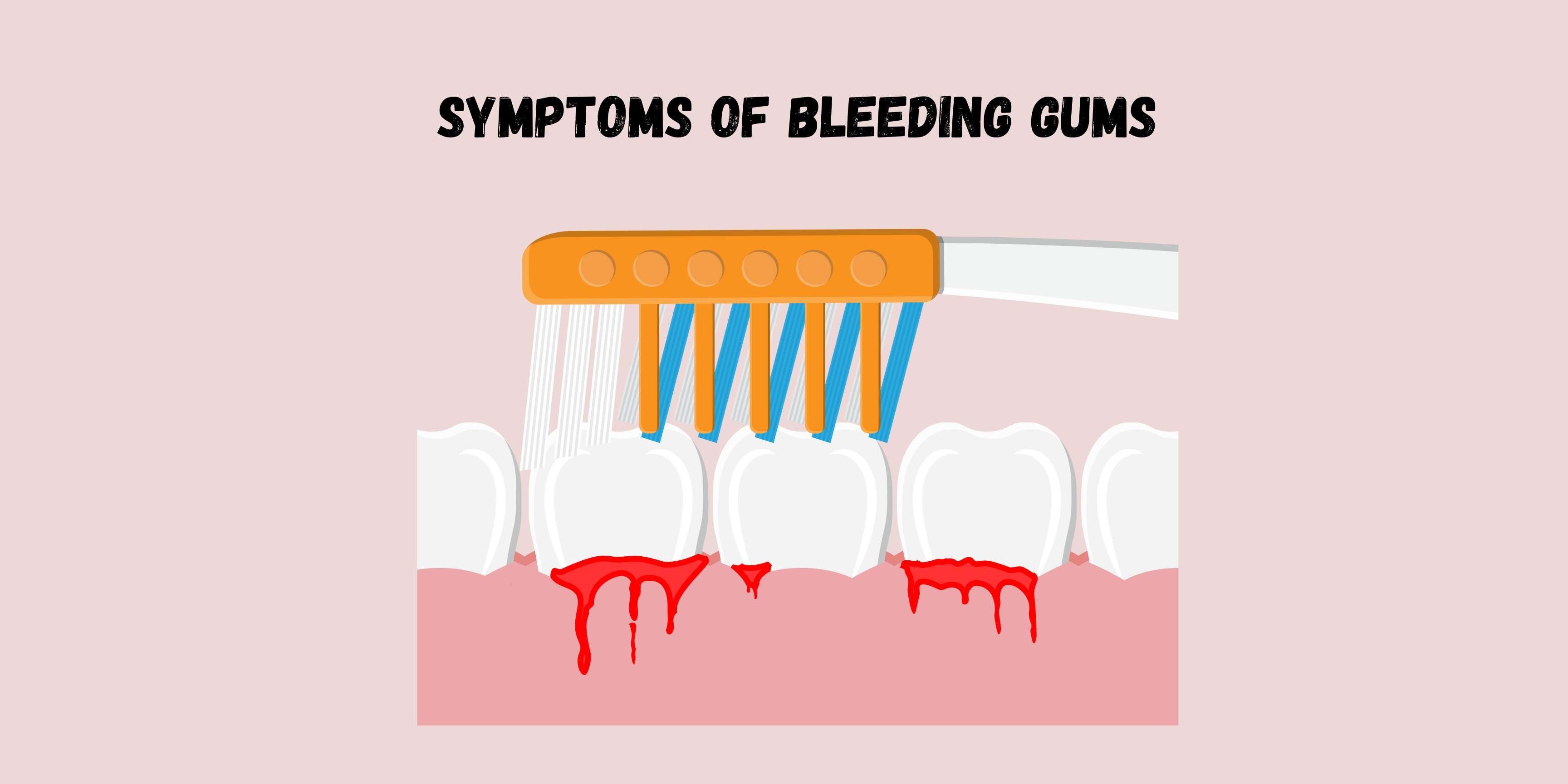 Symptoms of Bleeding Gums