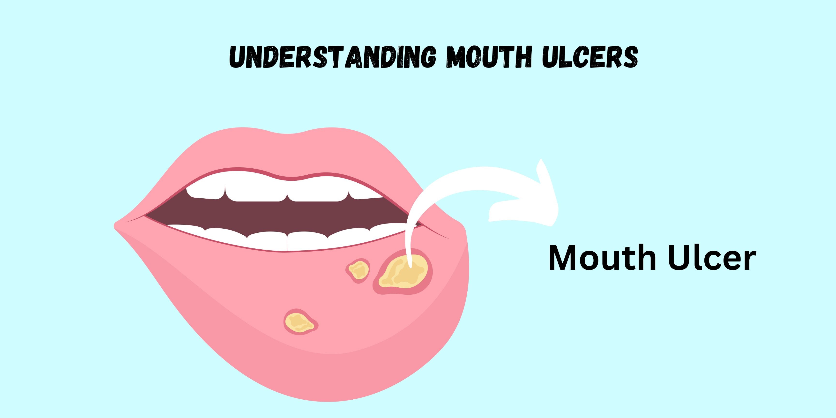 Understanding Mouth Ulcers