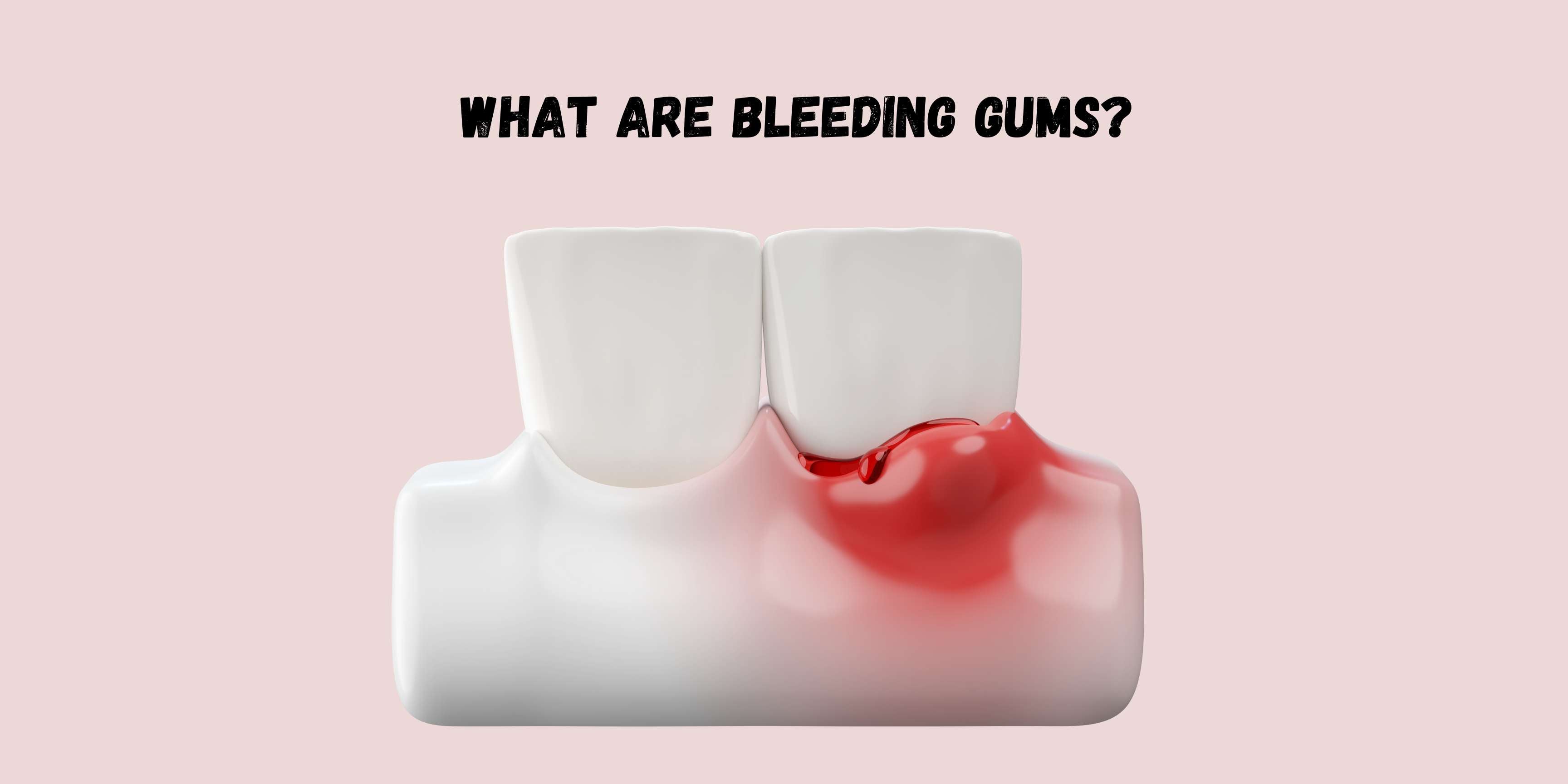 What are Bleeding Gums