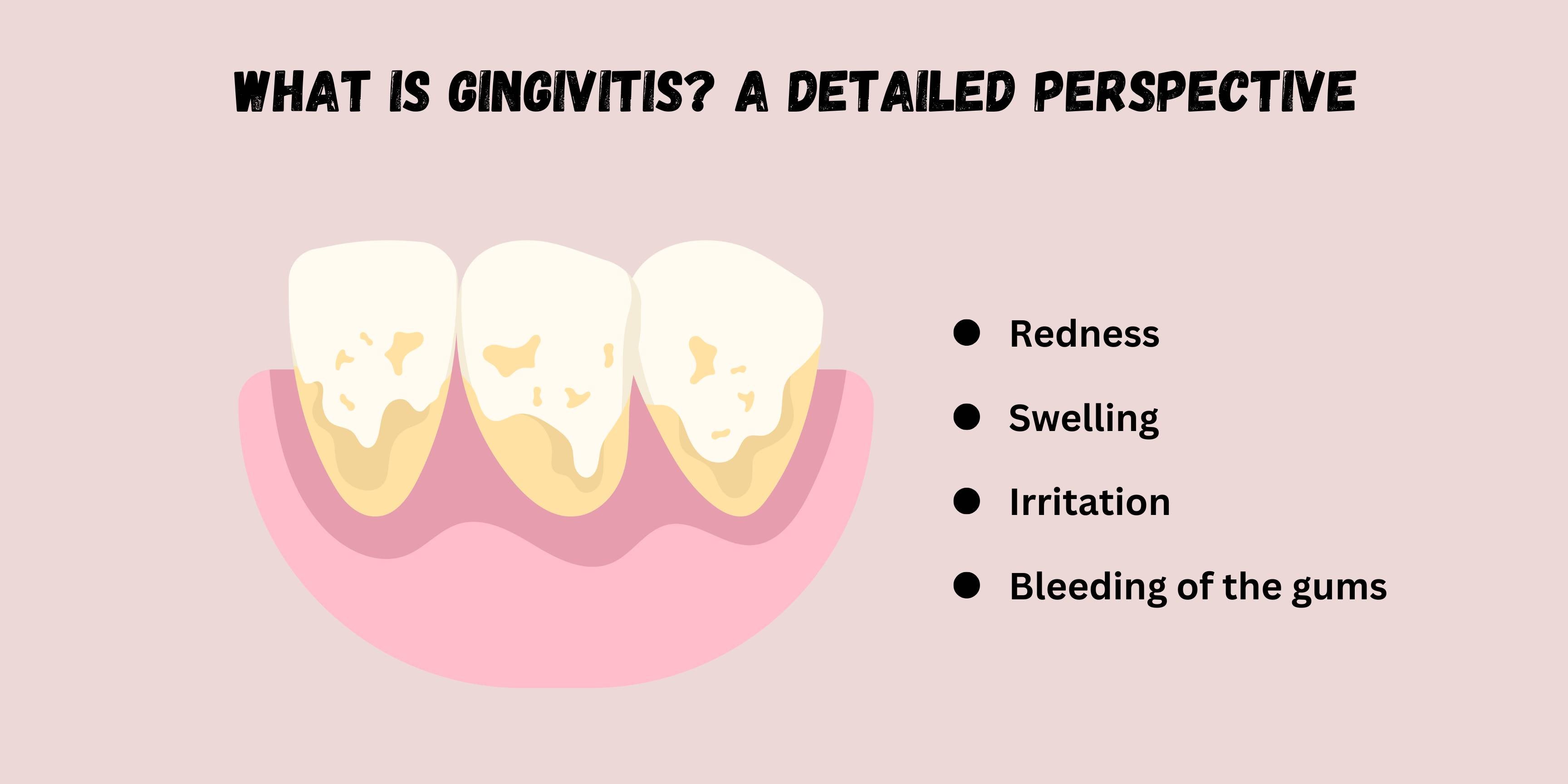 What is Gingivitis A Detailed Perspective