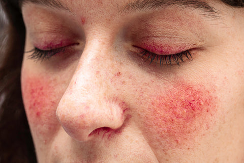 Eine Frau mit Hautrötungen im Gesicht