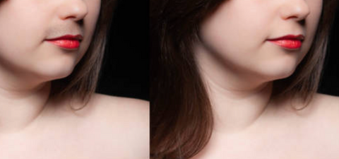 picture of woman with hair on upper lip before and after.