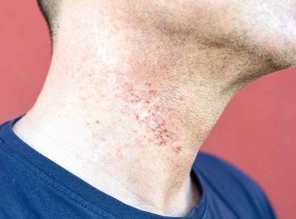 Neck Razor Burn Scars from Shaving
