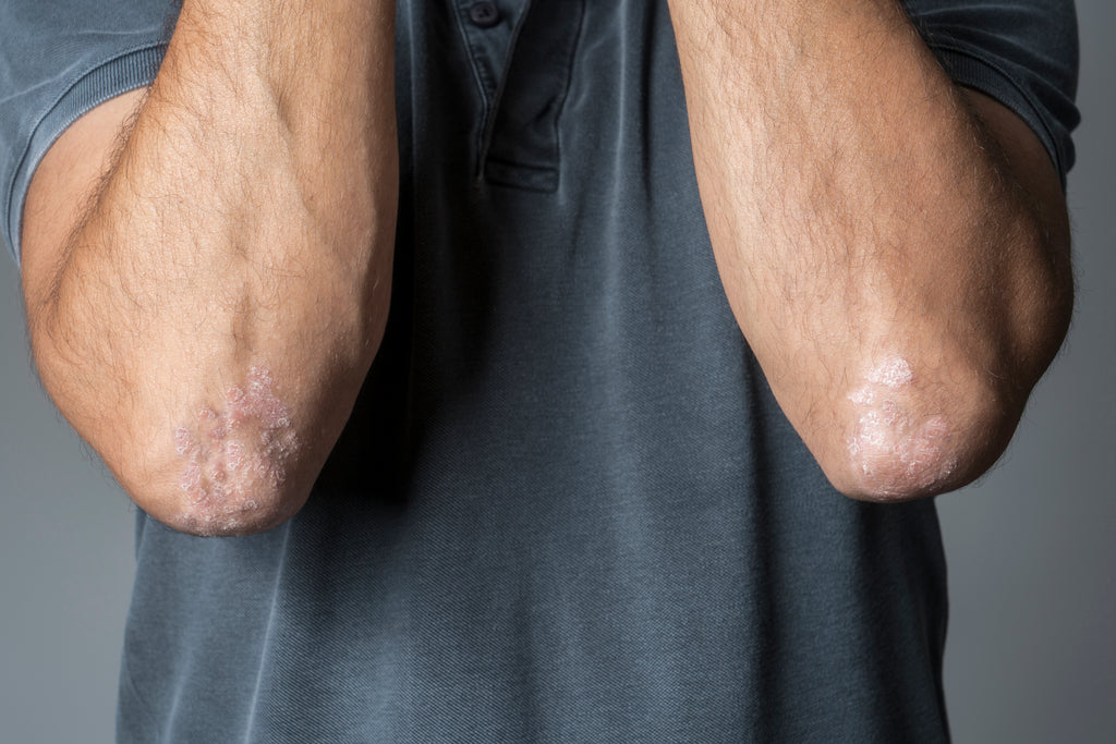 Psoriasis on elbows