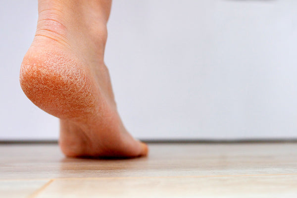 Our Best Tips For Treating & Preventing Cracked Heels