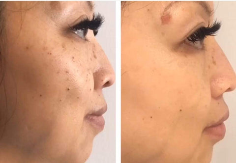 IPL treatments available at Gee Beauty