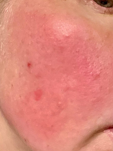 rosacea | luonkos