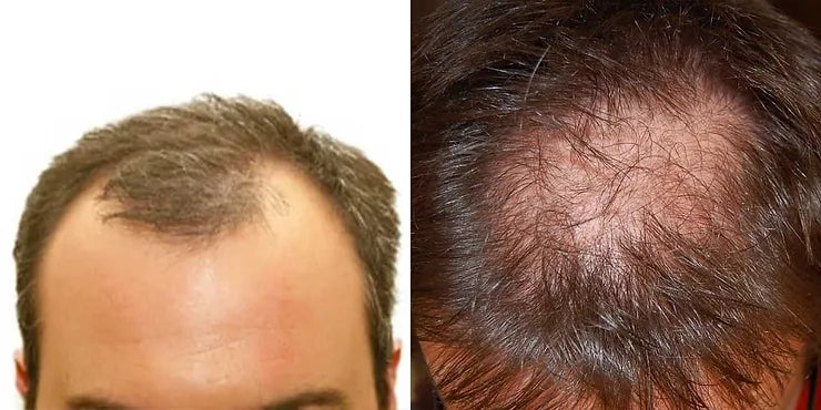 n men: alopecia androgenetica causes the scalp to become clearly visible at the crown and hairline as the hair becomes thinner and falls out.