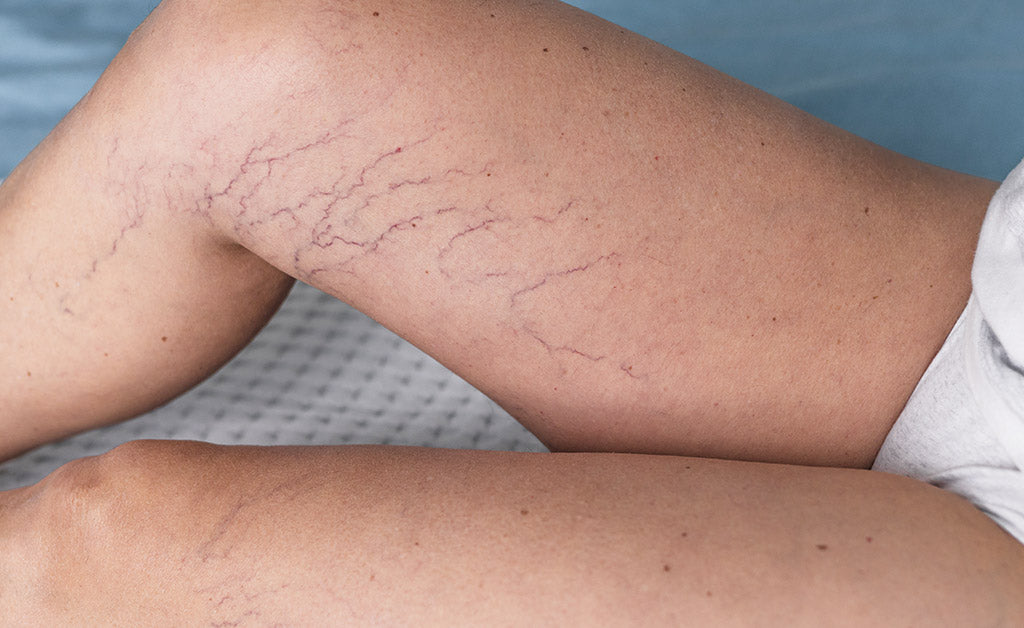 Compression Stockings for Varicose Veins