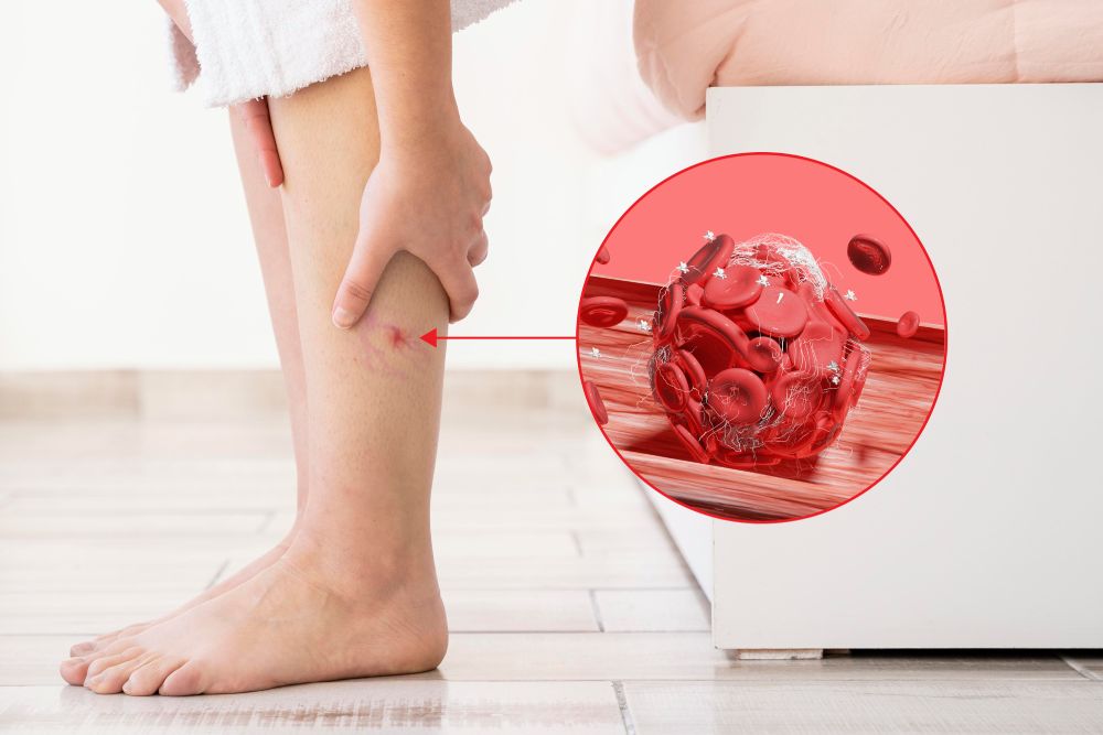 Lower the Risk of Blood Clots