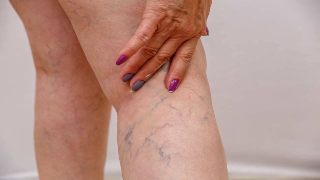 Varicose Veins