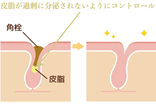 開き毛穴や黒ずみ毛穴、ニキビを予防<