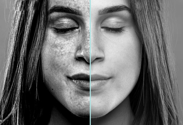 5 Things You Need to Know About Hyperpigmentation - Repêchage®